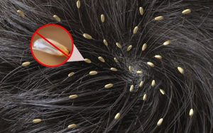 Mơ thấy đầu có chấy điềm báo về sự việc tương lai